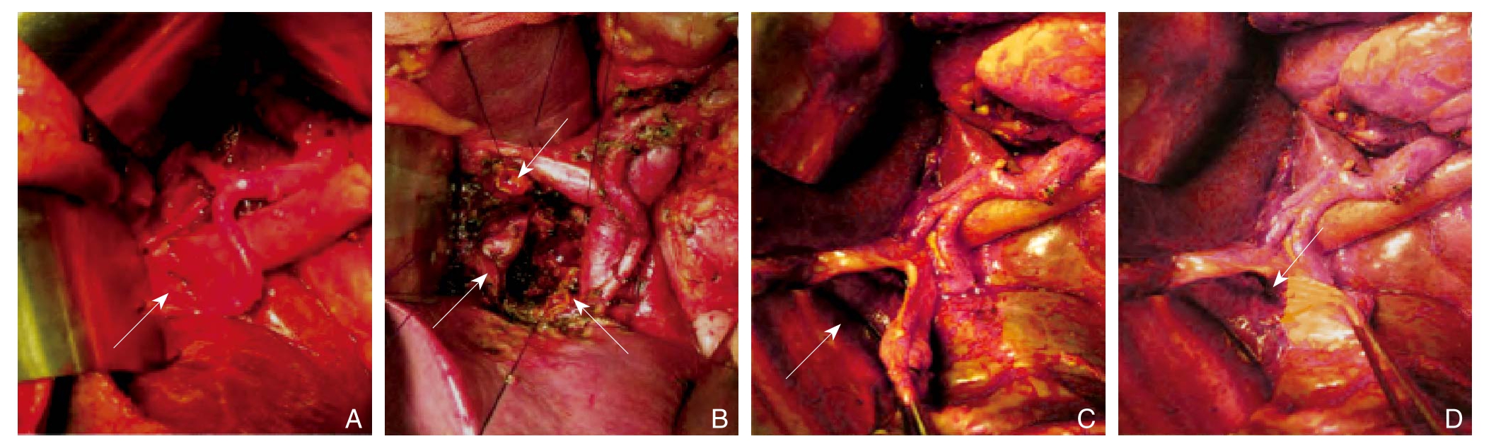 肝圆韧带间置肠肝吻合术在肝门区肿瘤外科治疗中的应用价值